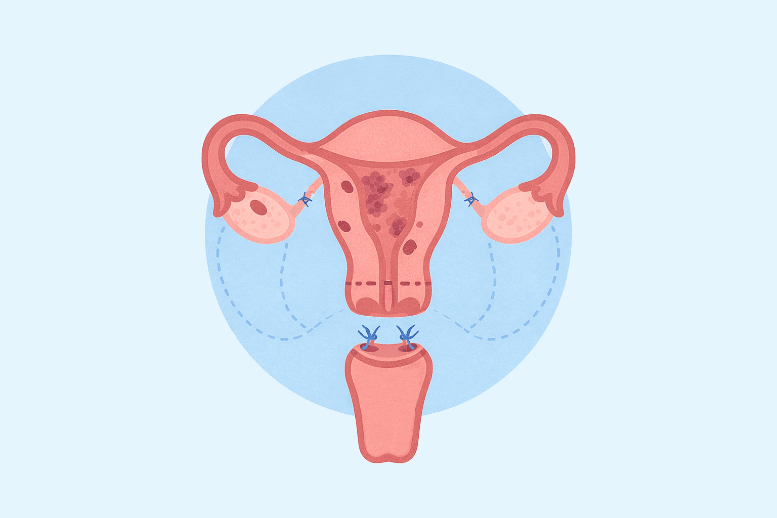 A flat illustration of a hysterectomy, depicting removal of the uterus, fallopian tubes, and ovaries.